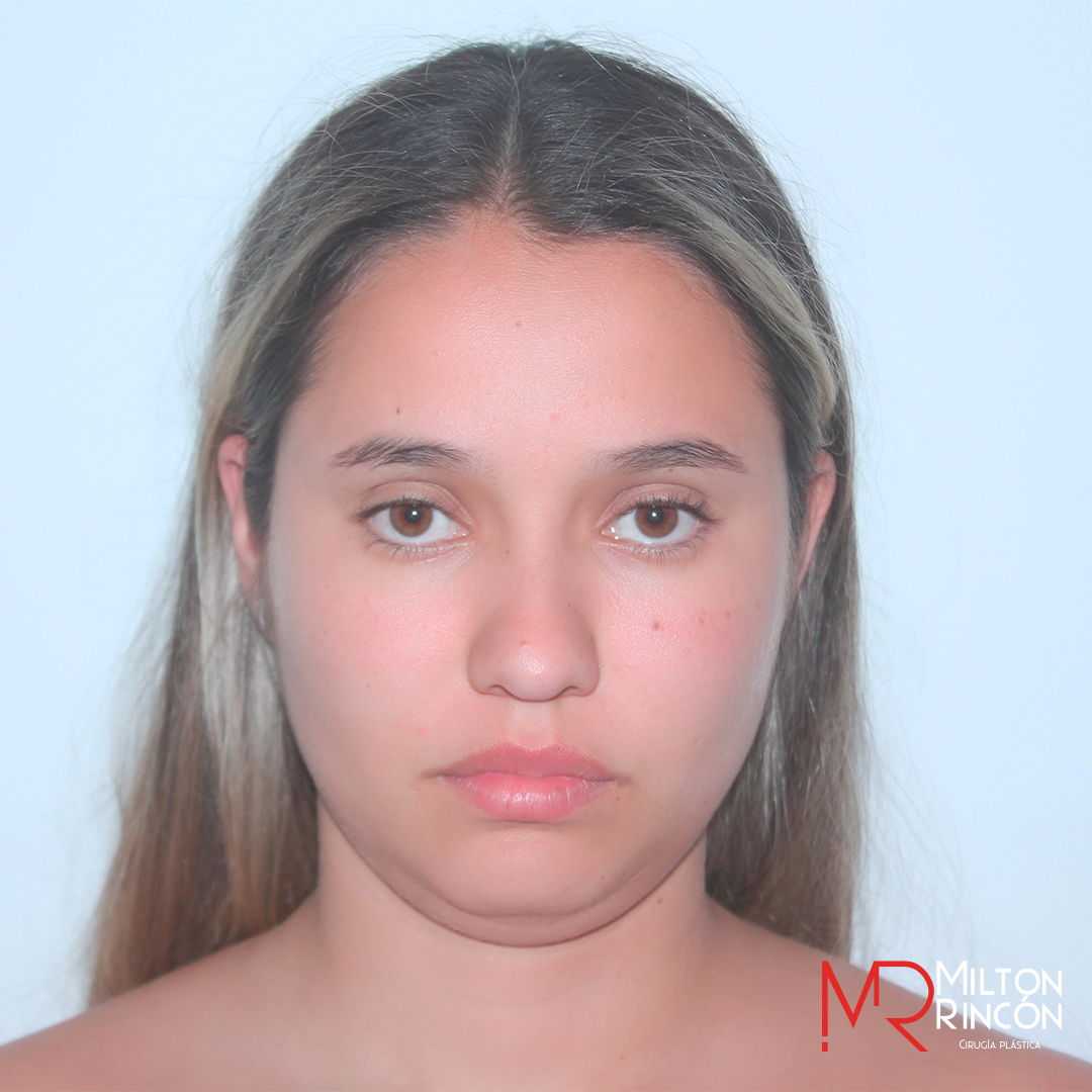 Caso Antes