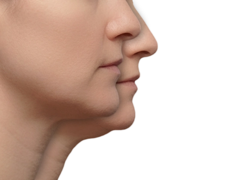 Liposucción facial y de cuello